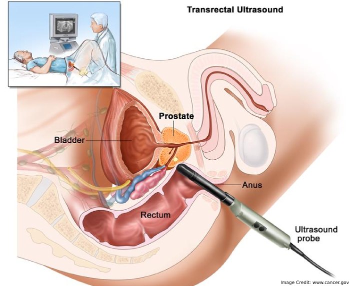 Transrectal Sonography