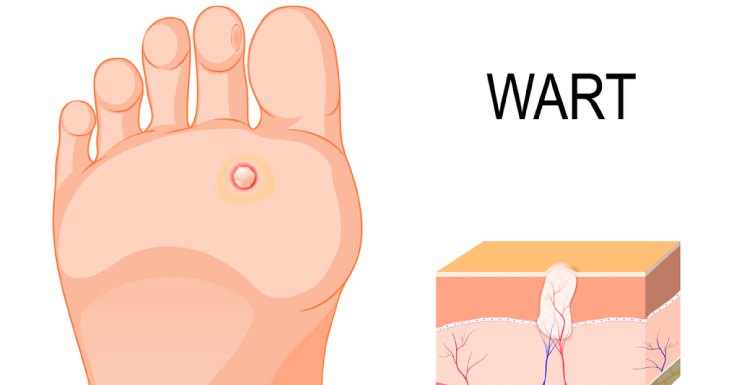 Risk factors Of HPV Infection