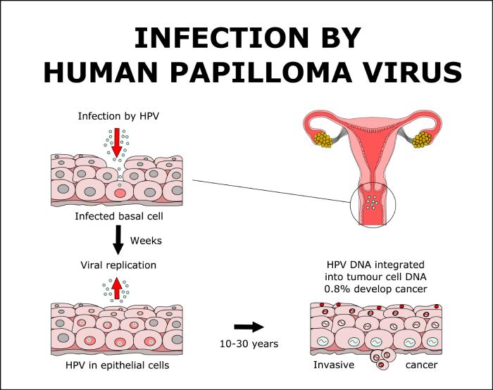 Symptoms of human papillomavirus hpv) Symptoms of human papillomavirus hpv)