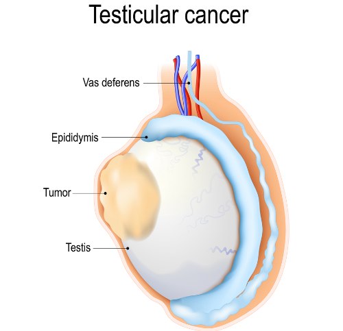 Testicular Tumors