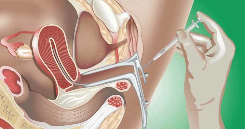 Assisted Reproduction