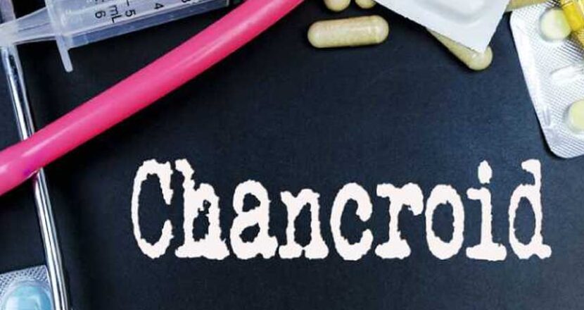 Chancroid: Learn the Facts About Chancroid (Sexually Transmitted Disease)