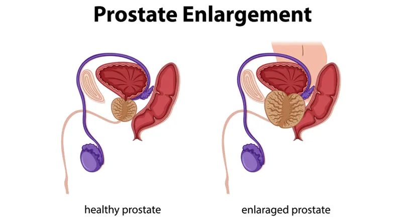 DHT and Prostate Enlargement: How It Drives Prostate Growth in Men