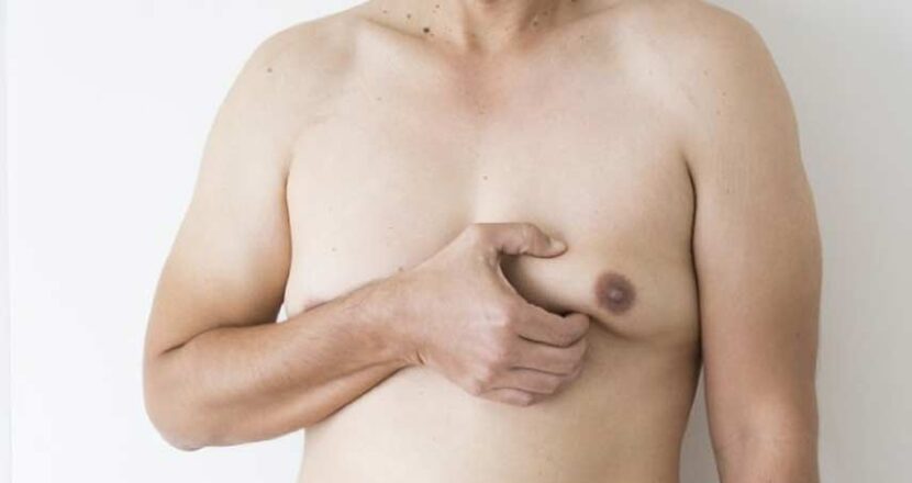 Things You Ought To Know About Gynecomastia