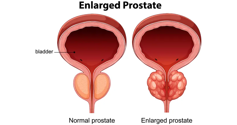 How to Shrink an Enlarged Prostate Naturally (2026 Guide for Better Urinary Health)