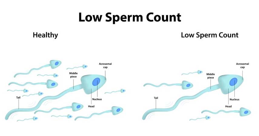 Outlook for Men with Oligospermia