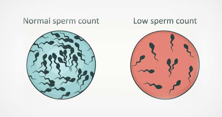 Pretesticular Azoospermia