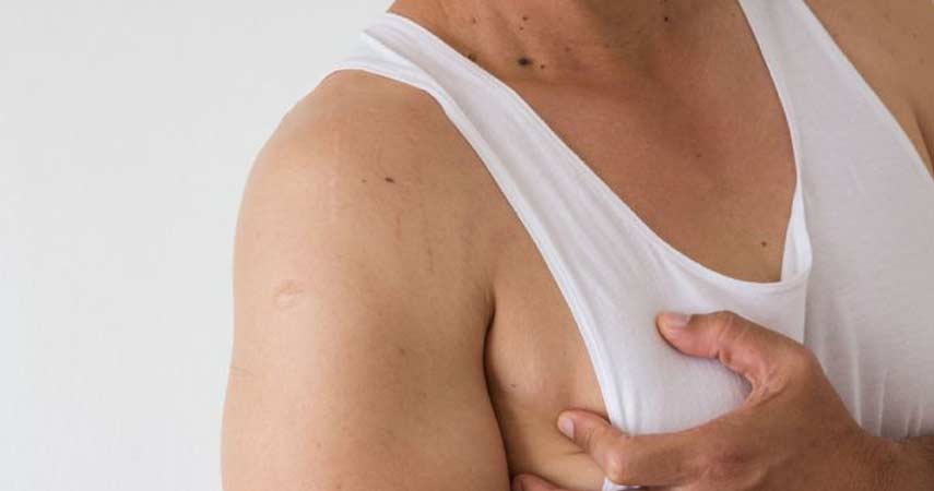 Symptoms Of Gynecomastia